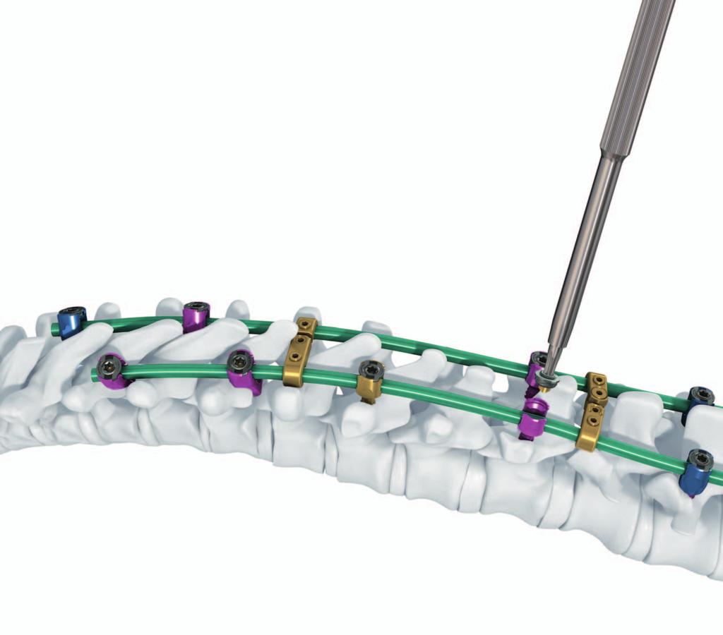 Pangea Spine System. Top loading pedicle screw and hook system for posterior stabilization and correction of spinal deformities.