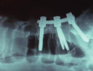 Indications and Contraindications The Pangea Spine System is a posterior pedicle screw and hook fixation system (T1 S2) designed to provide precise and segmental stabilization of the spine in