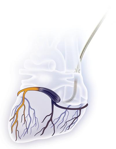 Antegrade DLP High Flow Coronary Artery Ostial Cannulae Hand-held or clamped placement options allow infusion directly into the coronary arteries.