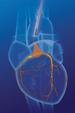 Choose from standard sized or elongated for enhanced retention and occlusion of middle cardiac vein.