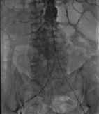 A B C D Figure 3. Angiographic image of the infrarenal abdominal aorta before endovascular intervention. Figure 4.