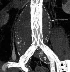 Angiography was then performed to substantiate excellent deployment (Figure 6C).