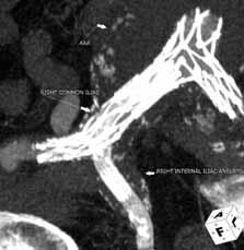 A Figure 7. Six-month CT image showing the integrity of the endograft without endoleak and residual aneurysms (A). CT image of the right common iliac and internal iliac with the snorkel technique (B).