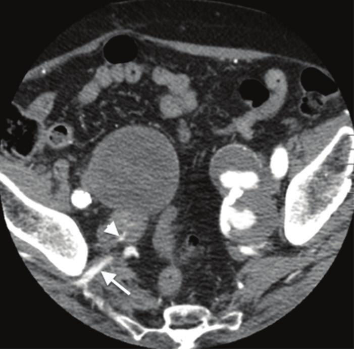 2 Case Reports in Vascular Medicine (a) (b) (c) (d) Figure 1: (a) Axial CT demonstrating bilateral internal iliac artery aneurysms, and contrast can be seen entering the right IIA aneurysm