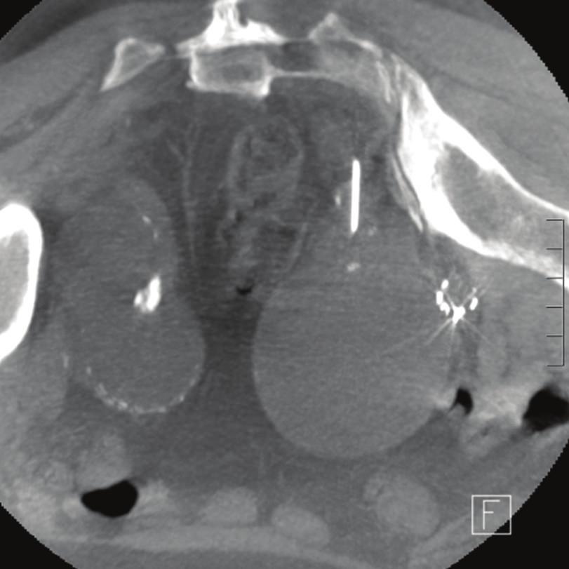 (c) Prone angiogram with the needle in the superior gluteal artery demonstrating communication with five feeding vessels.