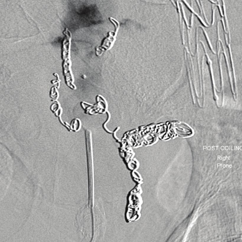 A dedicated CT angiogram performed 6 years after the IIA origin was covered showing the sac having expanded to a diameter 6.4 cm.