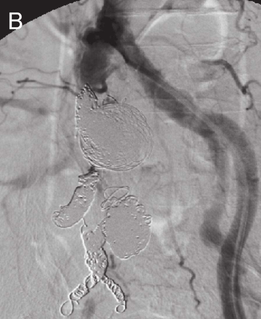 Aneurysm was located at the bifurcation of the right IIA and therefore, after forming a femorofemoral bypass, the distal part of the right IIA, aneurysm and the common iliac artery were embolized