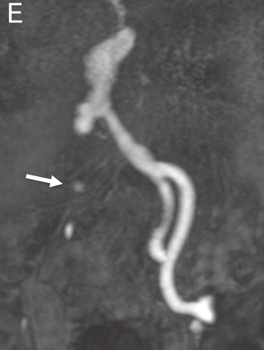 follow-up [4 7]. Situation is similar in case of visceral artery aneurysms.