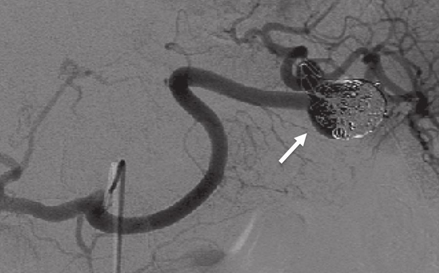 detecting aneurysms; however, metal artifacts limit its use after coil embolization [9].