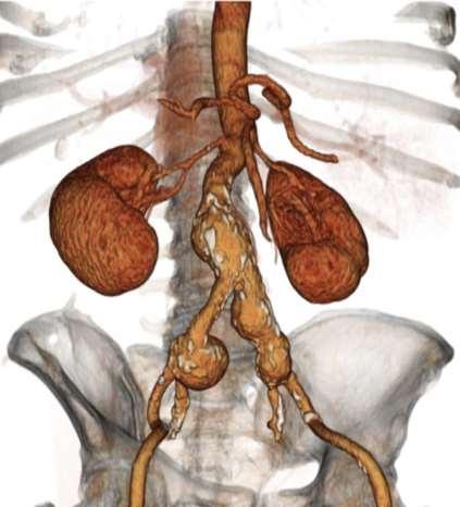 Common Iliac Artery Aneurysms (CIAAs) The majority of CIAAs are asymptomatic, but patients may present with rupture, distal embolization, thrombosis, or symptoms of visceral or neurologic