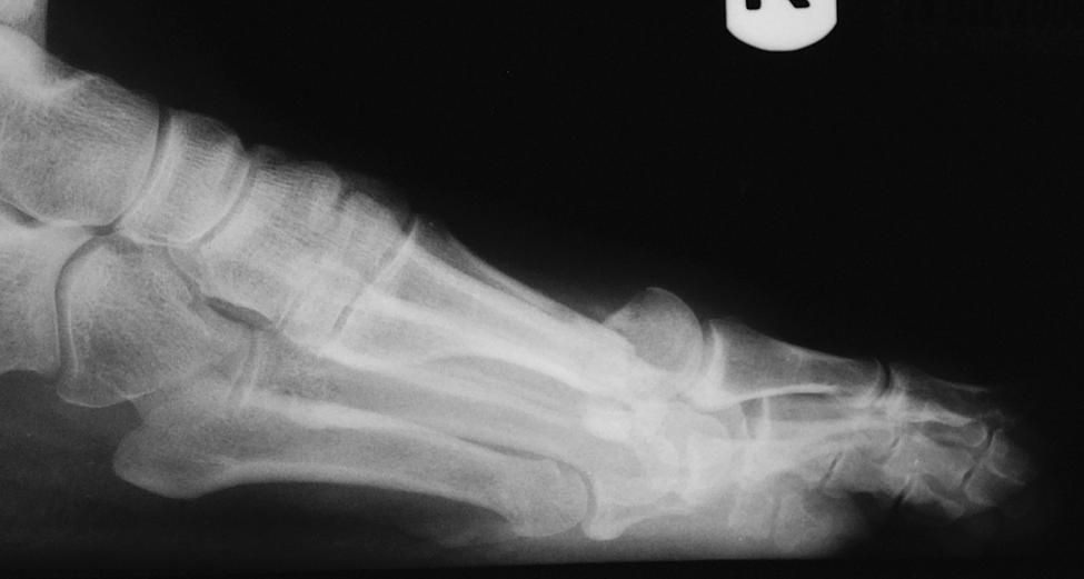 105 Figure 1C. Lateral view at 4 weeks postoperative. Figure 1 D Radiograph showing good alignment in both the transverse and sagittal planes as well as correction of preoperative hallux valgus.