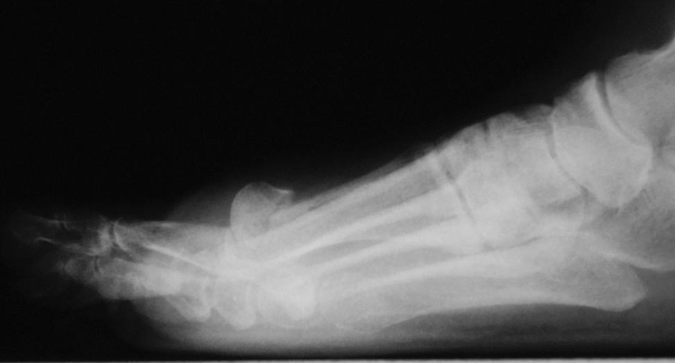 107 Figure 2C. Lateral view of postoperative radiograph showing displacement. Figure 2D.