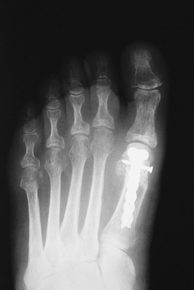 DISCUSSION Complications of hallux valgus surgery do occur, with the most frequently probably being recurrent deformity.