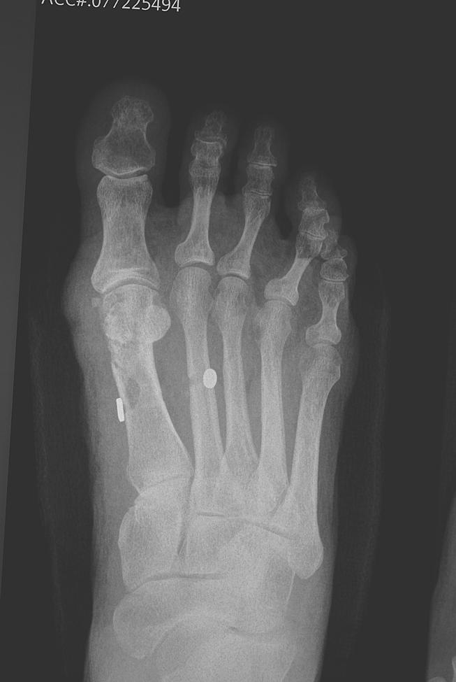108 pleased with their final result and one patient even requested that her other foot be corrected. The obvious plan of most surgeons is to avoid complications.
