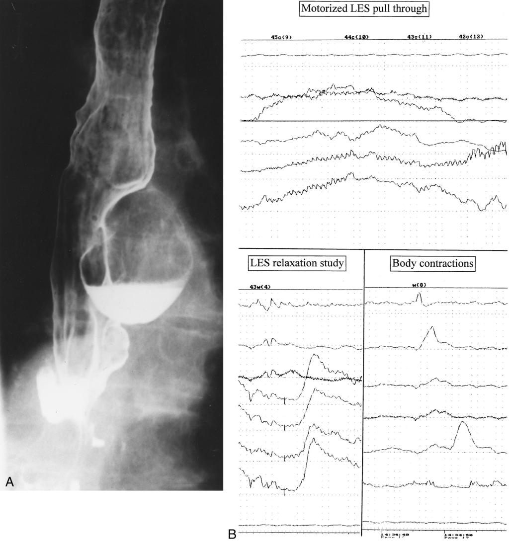 Vol. 235 No. 3 Epiphrenic Diverticulum 351 Figure 2. (A) Barium esophagogram of a patient with multiple diverticula.