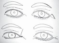 Blepharoplasty Lateral tarsal strip tightening procedure [Figure 8] An incision is made along the crease lateral to the lateral canthus. The lower limb of the lateral canthal ligament is divided.