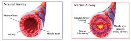 What is Asthma?