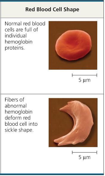 1. Below is an image of two red blood cells. One image shows a normal red blood cell with a biconcave shape, the shows an abnormal red blood cell with a sickled shape.