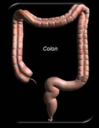 Colorectal Cancer The Ideal Population Marker Detect all CRC &