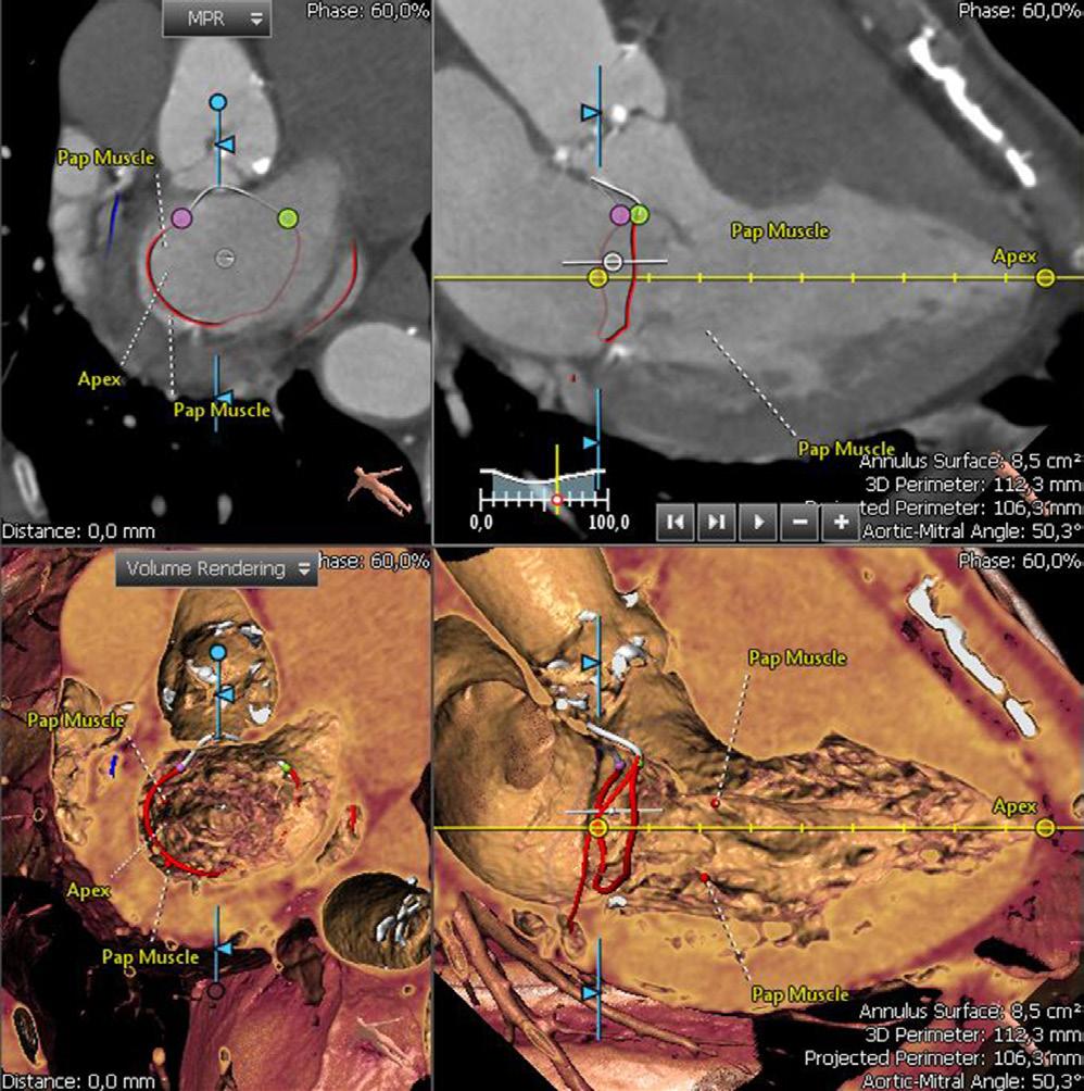Page 2 of 5 Journal of Visualized Surgery, 2016 Figure 1 CT-scan reconstruction of the left heart, mitral annulus. Valve pathology is another important issue to consider.
