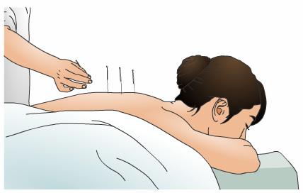 Acupuncture Acupuncture is like acupressure and based on the same beliefs.