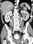 the ureters and the bladder. Below are three cases of bladder cancer that highlight different facts (Fig. 4).