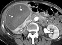 Fig. 11a. Post-contrast axial view. Fig. 11b. Coronal MPR. Fig. 11. The large subcapsular haematoma is noted compressing and distorting the kidney.