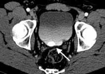 seen on the precontrast series image not included) Fig. 13a. Axial post-contrast view.