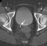 bladder seen pre-contrast and not hidden by contrast shows calculus within