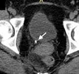 ureteric jets into bladder, confirming obstruction on the right is only partial in Fig.