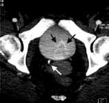 Axial view of the ureters. Fig. 12d. Axial view of the bladder. of the urinary tract.