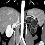 Atrophy of the left renal artery b).