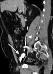 14a. Axial renal. 14b. Contrast in ileal bladder. 14c. Sagittal MPR 14d. Sagittal view of right ureter. bladder. Fig 14.
