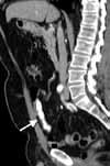 This case was included to highlight the use of this scan technique in the unusual situation of assessing the urinary tract after diversion surgery.