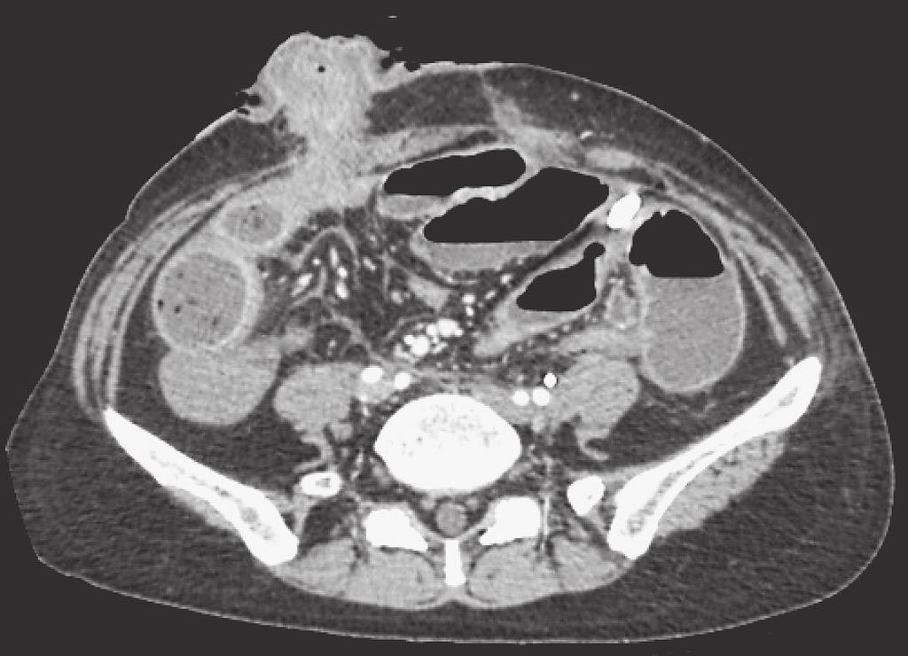 J Anus Rectum Colon 2018; 2(1): 25-30 Figure 1. Computed tomography image of the case who develop outlet obstruction. The ileum just before the outlet site of ileostomy is dilated (arrow).