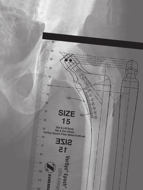 Using a VerSys Epoch FullCoat Hip 1 Dorr Type A and B: Dorr Type A femurs are characterized by the champagne-flute shaped canal with narrow diaphysis.