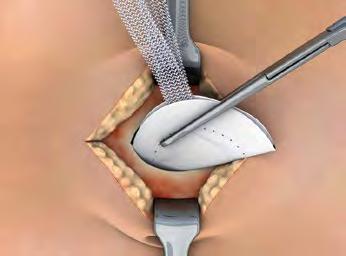 Proven Technique Clinical Summary 2 Ventralex Mesh in Umbilical/Epigastric Hernia Repairs: Clinical Outcomes and