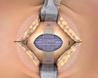 The smallest Ventralex ST Hernia Patch allows for an intraabdominal,