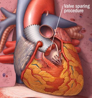 VSRR Potential rationale for Valve-Sparing Root Replacement Excellent aortic valve function with physiological
