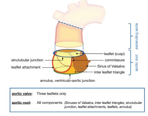Proximal aortic anastomosis: Anatomy of the aortic root: implications