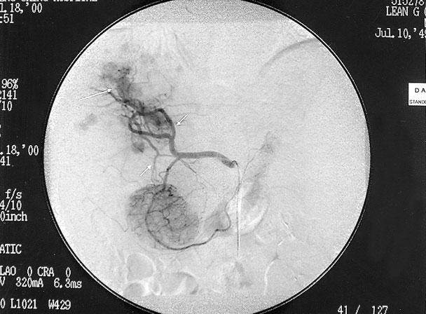 (Fig. 2). The main portal vein and left portal vein were patent, but occlusion of the right inferior portal vein was seen. There was no tumor thrombus in the portal vein.