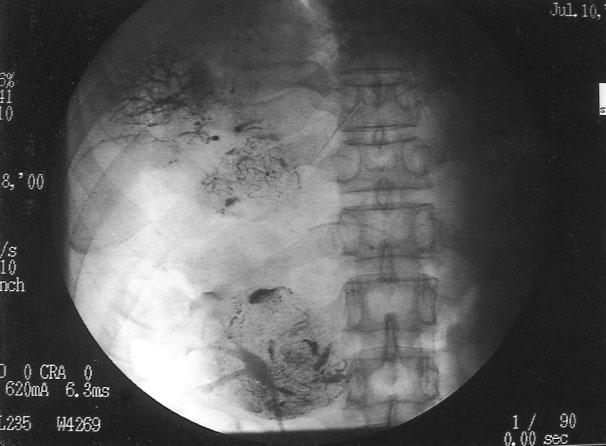 Gelfoam particles (1 1 mm & 0.5 0.5 mm) for partial embolization. TAE was performed later from the right hepatic artery.