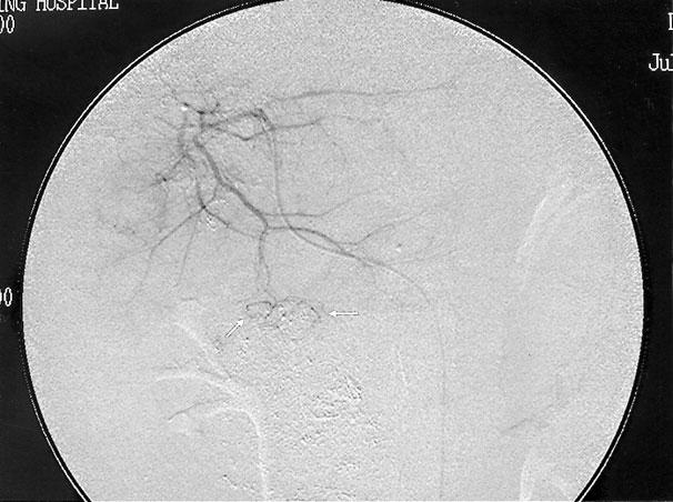 Emergent angiography of the left hepatic artery revealed early recanalization of the occluded peripheral branches of left hepatic artery (Fig. 6).