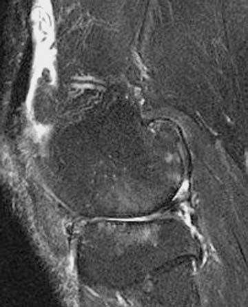 Nang xương dưới sụn: là các ổ ranh giới rõ nét có tăng tín hiệu trên xung T2W nằm ở vùng xương dưới sụn.