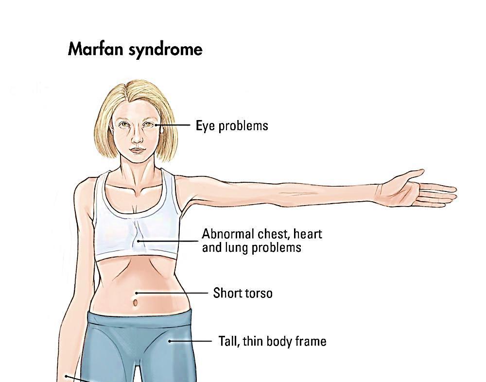 Lens dislocation Marfan syndrome A genetic defect in