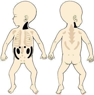 Distribution of multilocular adipose tissue In humans the tissue is important mainly in the first postnatal life (produces heat and protects the newborn against cold) It is greatly reduced in