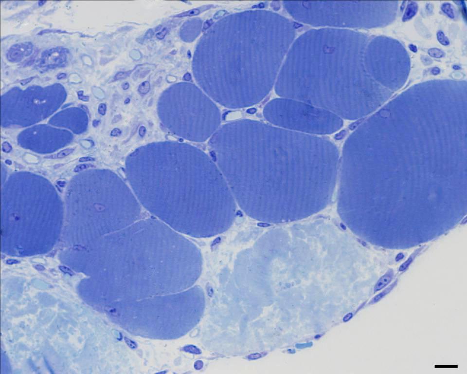 LGMD2B CN: Central nucleus Regenerating fibre PI CN FL FS: Fibre splitting Early hyperplasia FL: Fibre lobulation Late hyperplasia PN LI: Leukocyte infiltration Inflammation NF: Necrotic fibre