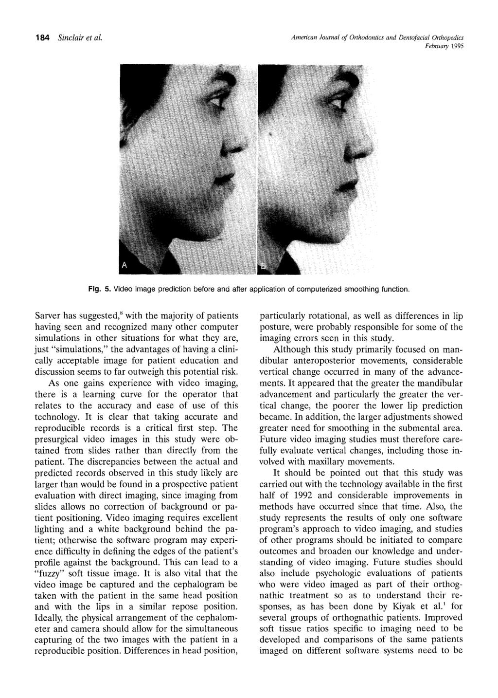 184 Sinclair et al American Journal of Orthodontics and Dentofacial Orthopedics February 1995 Fig. 5. Video image prediction before and after application of computerized smoothing function.