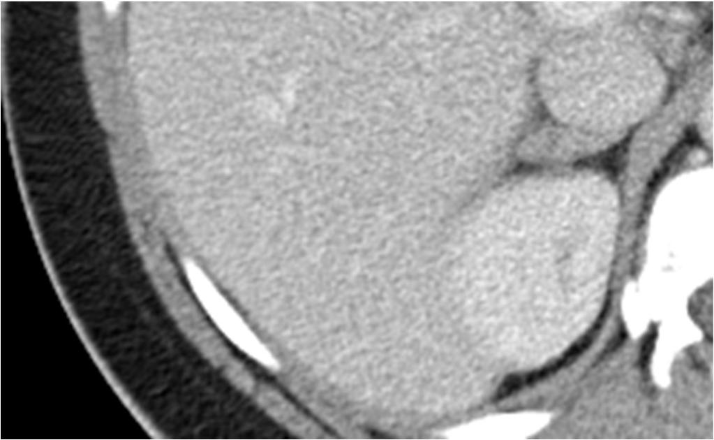 AVS Case 4: Results of Bilateral Adrenal Venous Sampling Vein R adrenal