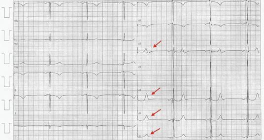 The early repolarization is a frequent pattern in the athletes ECG and it is a sign of physiologic heart adaptation to exercise, especially in young athletes, in males and Afro- American ethnicity,